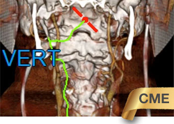 Right_Vert_Compression_feature_CME