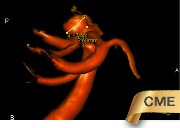 Ruptured_Basilar_Aneurysm_featured_CME
