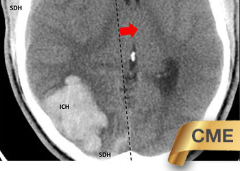 Young_college_student_with_severe_headache_CME_Feature
